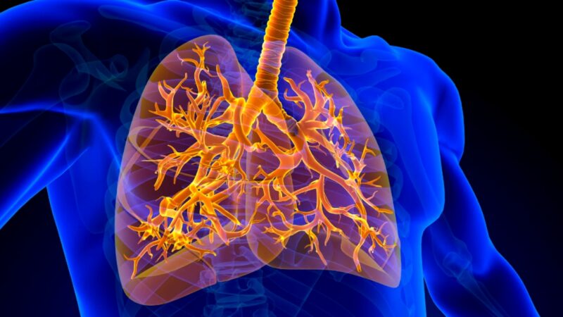 Understanding Interstitial Lung Disease: A Comprehensive Guide