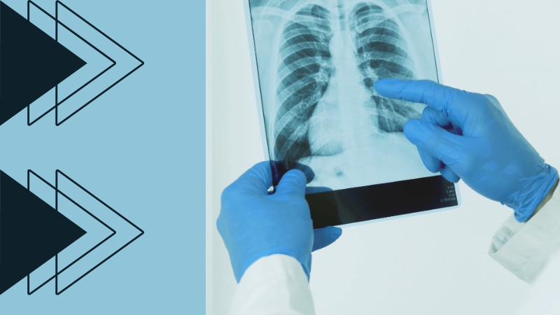 Ventilator-associated pneumonia