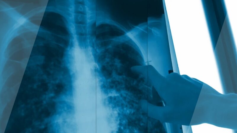 Emphysematous changes-chronic lung condition