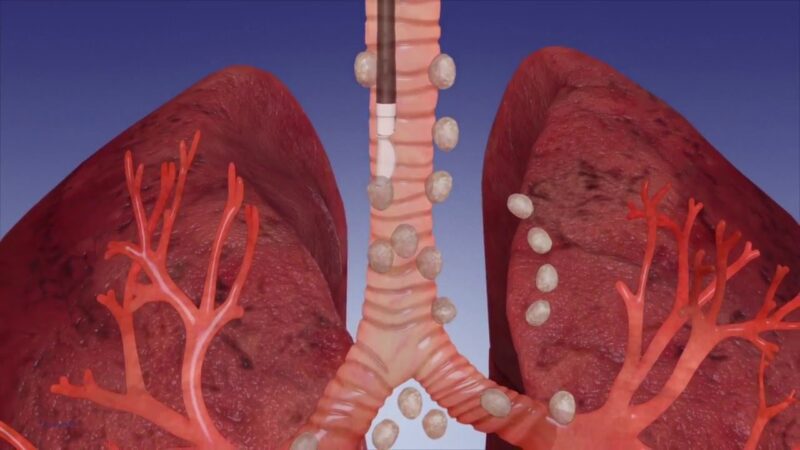 CPT and Diagnosis Codes for Bronchoscopies